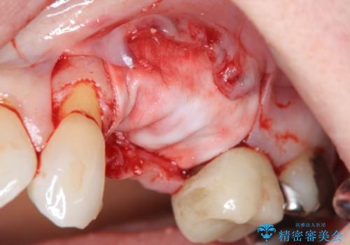 骨の造成を伴うインプラント治療の治療前
