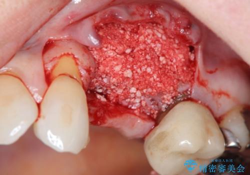 骨の造成を伴うインプラント治療の治療前