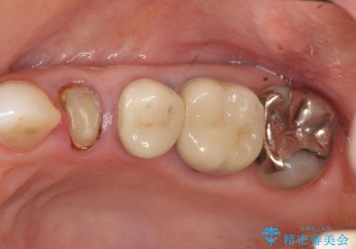 骨の造成を伴うインプラント治療の治療前