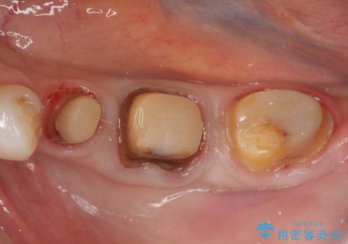 歯ぐきの腫れを改善する歯周外科手術を伴うセラミック治療の治療中