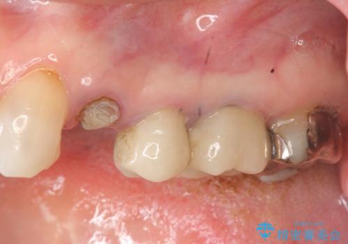 骨の造成を伴うインプラント治療の治療前