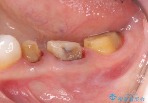 歯ぐきの腫れを改善する歯周外科手術を伴うセラミック治療の治療前
