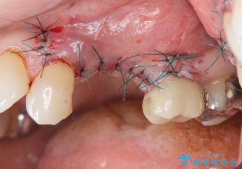 骨の造成を伴うインプラント治療の治療前