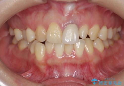 [ 前歯セラミック治療 ]白く不自然な前歯をきれいにしたいの治療前