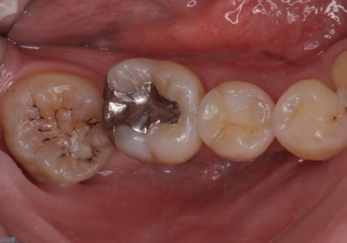 詰め物の下が虫歯 つぎはぎの歯をしっかり治療の治療前