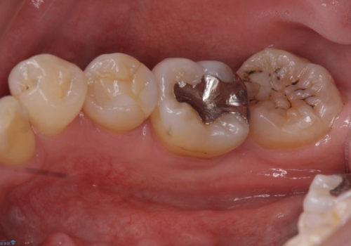 詰め物の下が虫歯 つぎはぎの歯をしっかり治療の治療前