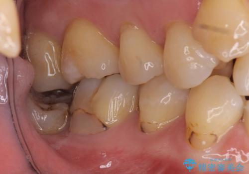 詰め物の下が虫歯　つぎはぎの歯をしっかり治療の治療前