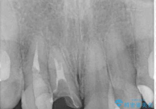 前歯のクロスバイトと治療が必要なむし歯 矯正とセラミックの総合歯科治療の治療前
