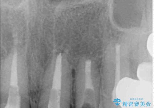 もげてしまった前歯をセラミッククラウンで自然にの治療前