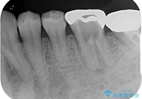 痛む奥歯と矯正の後戻り インビザライン・ライトとセラミック治療の治療前