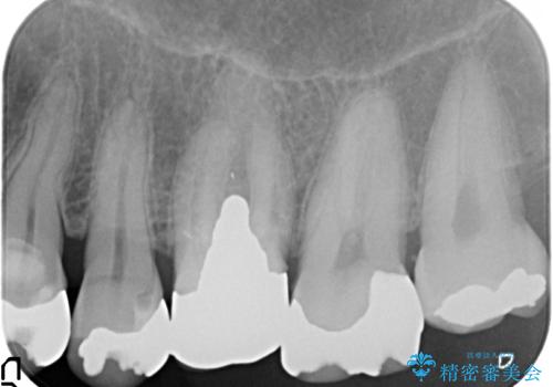 臼歯部インプラント・再補綴の治療前