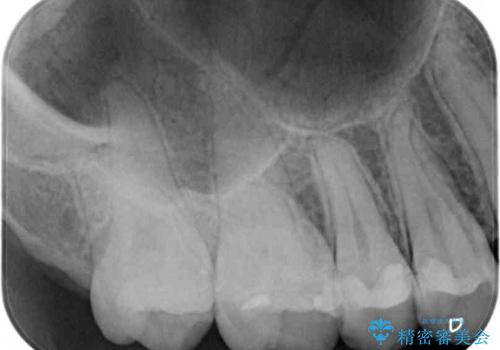 奥歯のむし歯をゴールドインレーで修復の治療前