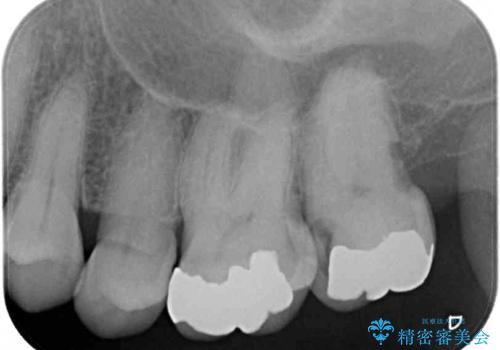 歯に穴が空いてしみる　ものが挟まってしまうほど大きな奥歯のむし歯の治療前