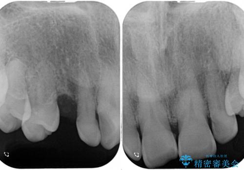 乳歯や矮小歯の多い前歯 部分矯正と補綴治療による審美歯科治療の治療前