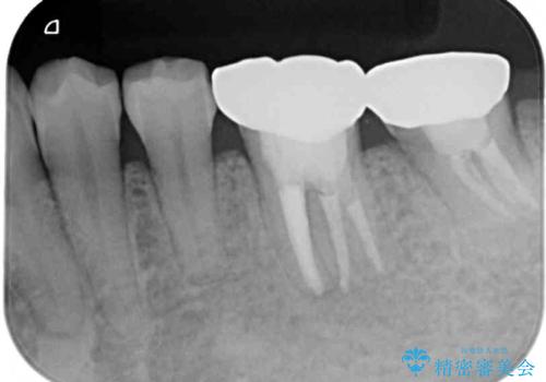 痛む奥歯と矯正の後戻り インビザライン・ライトとセラミック治療の治療後