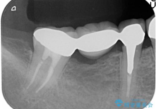 臼歯部メタルフリー再補綴の治療前