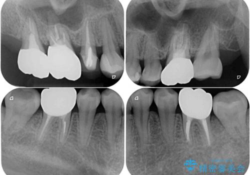 気になる前歯をインビザライン・ライトで 矯正治療後には銀歯をセラミックにの治療後