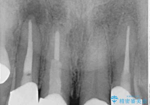 痛む奥歯と見栄えの悪い前歯　オールセラミックによる補綴治療の治療後