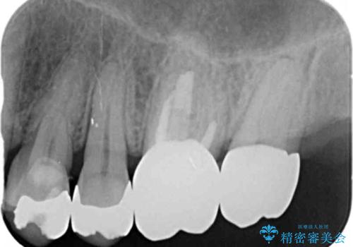 臼歯部インプラント・再補綴の治療後