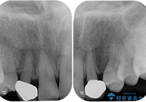 乳歯や矮小歯の多い前歯 部分矯正と補綴治療による審美歯科治療の治療後
