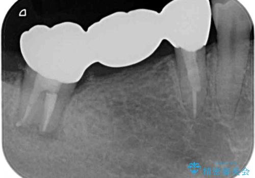 痛む奥歯　目立つ銀色の奥歯をセラミックに　セラミックブリッジの治療後