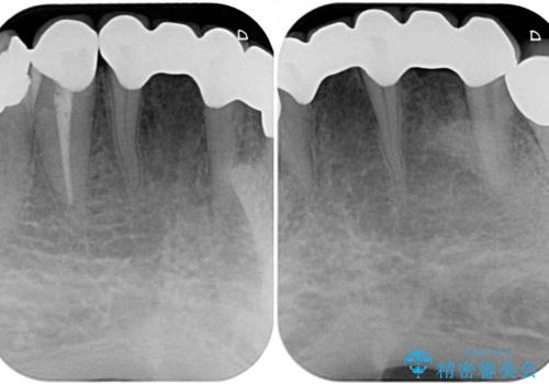 乳歯や矮小歯の多い前歯 部分矯正と補綴治療による審美歯科治療の治療後