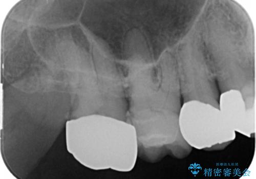 歯磨きすると痛い 不適合なクラウンのやりかえ 70代女性の治療前