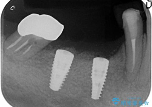 骨が薄く他院でインプラントできないと言われた 50代女性の治療中