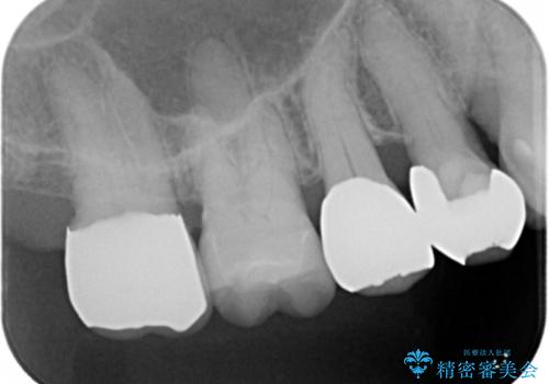 歯磨きすると痛い 不適合なクラウンのやりかえ 70代女性の治療後