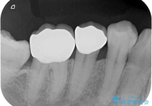 詰め物の下が虫歯 つぎはぎの歯をしっかり治療の治療後