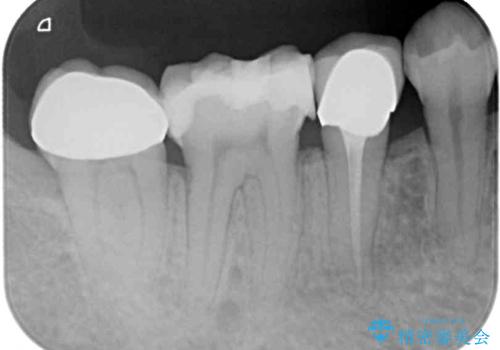 奥歯がしみる 色々な国で治療を受けてきた奥歯のむし歯治療の治療前