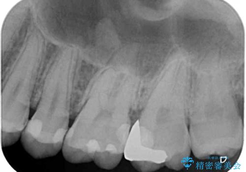 奥歯のむし歯をゴールドインレーで修復の治療前