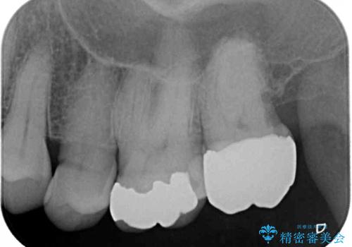 歯に穴が空いてしみる ものが挟まってしまうほど大きな奥歯のむし歯の治療後