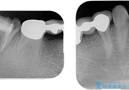 割れてしまった奥歯をインプラントで　気になる銀歯もセラミッククラウンで審美的にの治療前