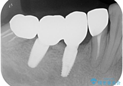 骨が薄く他院でインプラントできないと言われた 50代女性の治療後
