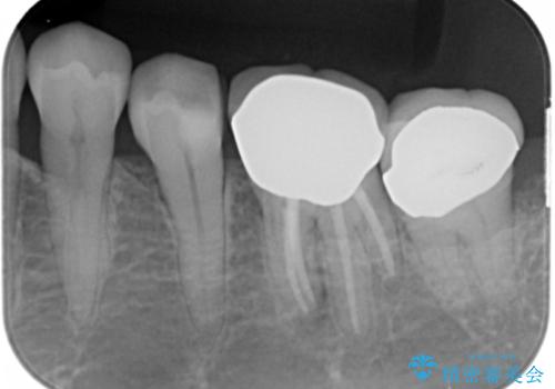 詰め物の境目が黒くて気になる 40代女性の治療前