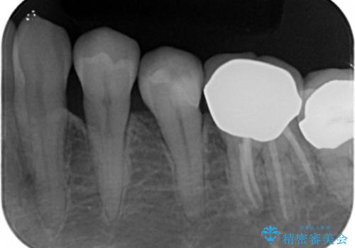 詰め物の境目が黒くて気になる 40代女性の治療後