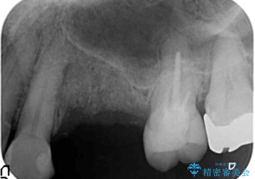 骨の造成を伴うインプラント治療の治療前