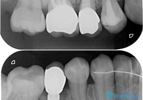 前歯のクロスバイトと治療が必要なむし歯 矯正とセラミックの総合歯科治療の治療後