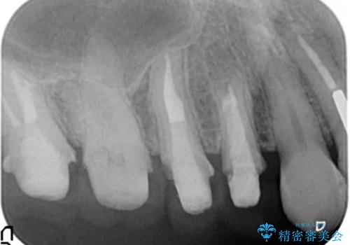 臼歯部メタルフリー再補綴の治療中