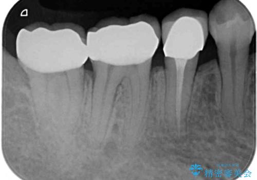奥歯がしみる 色々な国で治療を受けてきた奥歯のむし歯治療の治療後