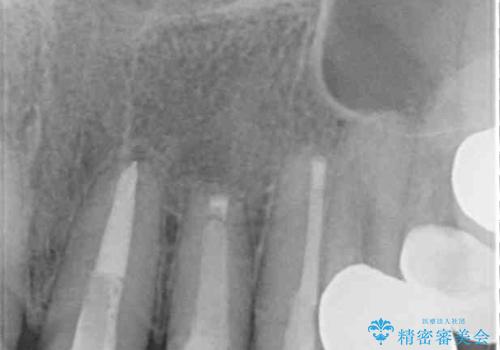 もげてしまった前歯をセラミッククラウンで自然にの治療後