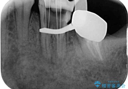痛む奥歯と矯正の後戻り インビザライン・ライトとセラミック治療の治療中