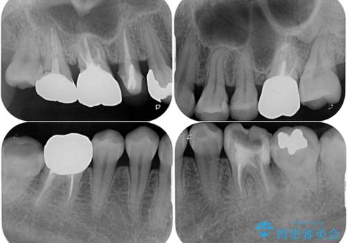 気になる前歯をインビザライン・ライトで 矯正治療後には銀歯をセラミックにの治療前