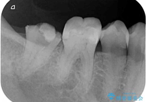 もげてしまった奥歯 部分矯正で清掃性の良い補綴治療の治療前