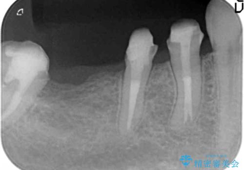臼歯部メタルフリー再補綴の治療中
