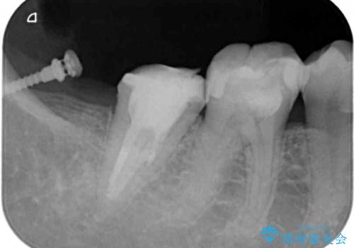 もげてしまった奥歯 部分矯正で清掃性の良い補綴治療の治療中