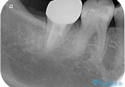 もげてしまった奥歯 部分矯正で清掃性の良い補綴治療の治療後