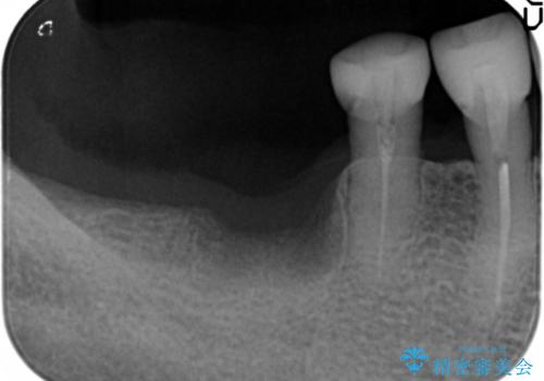 奥歯のインプラント　70代男性の治療前