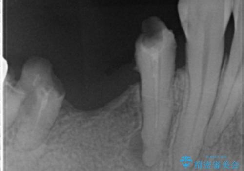 骨が薄く他院でインプラントできないと言われた 50代女性の治療前
